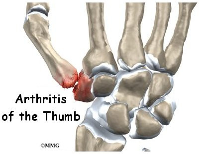 Base of thumb arthritis…how do I treat it?