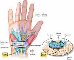 Carpal Tunnel Surgery Perth