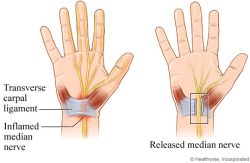 What is Carpal Tunnel Surgery