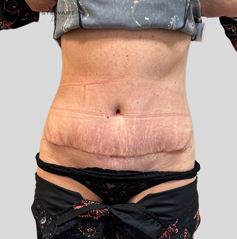 After 6 weeks