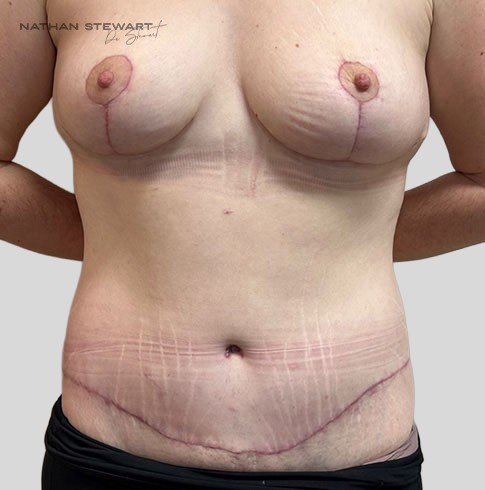 After 6 weeks 